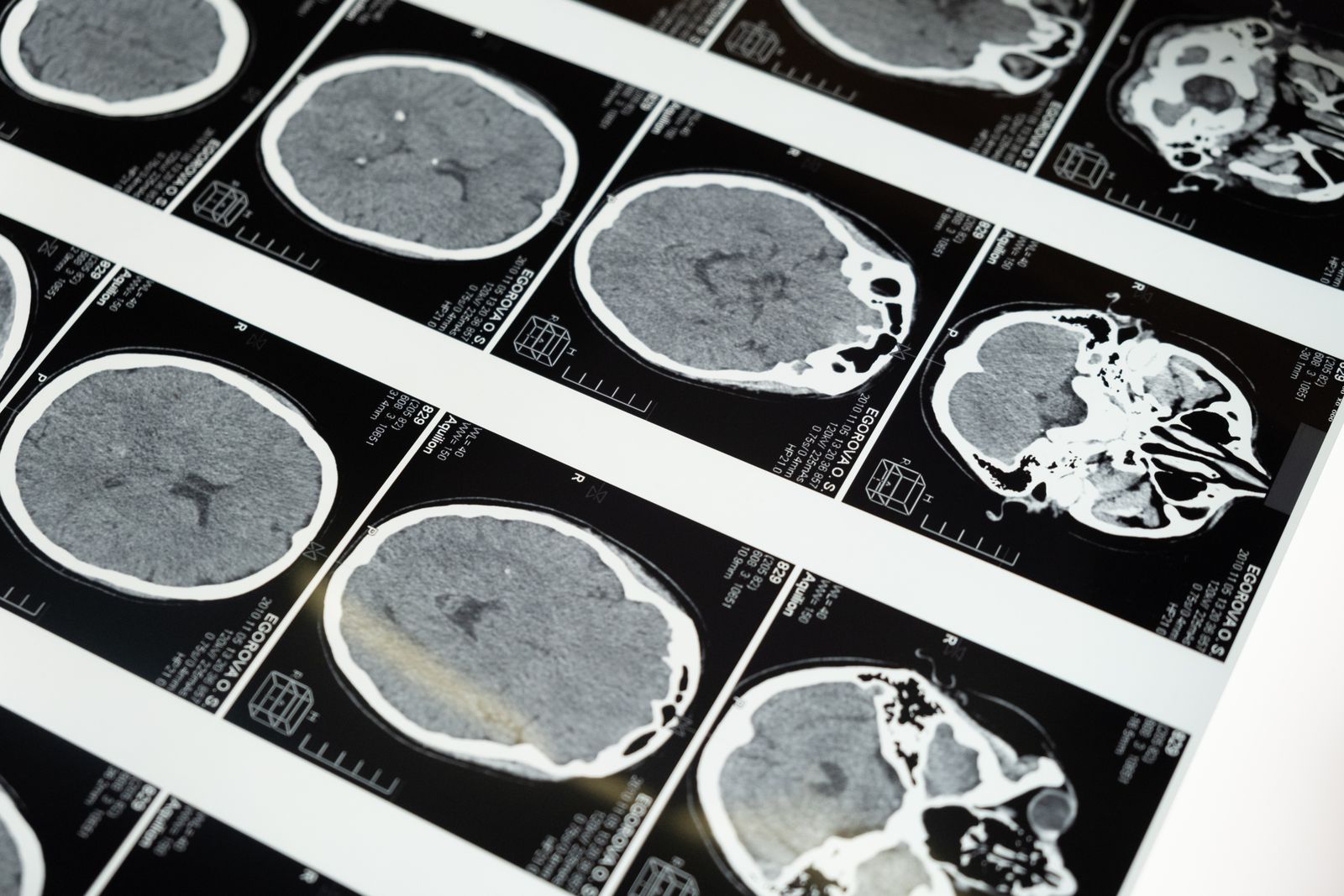Film displaying several cross-sectional brain images